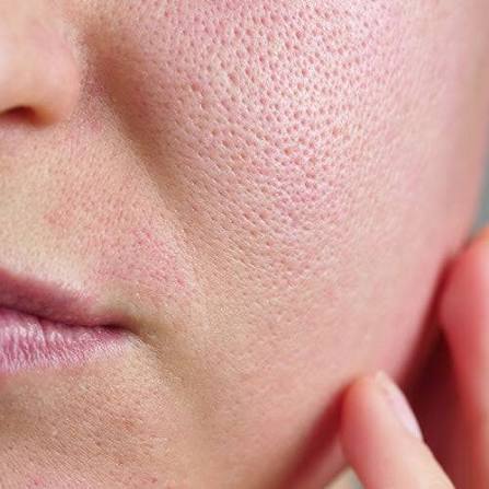 Visible, enlarged pores