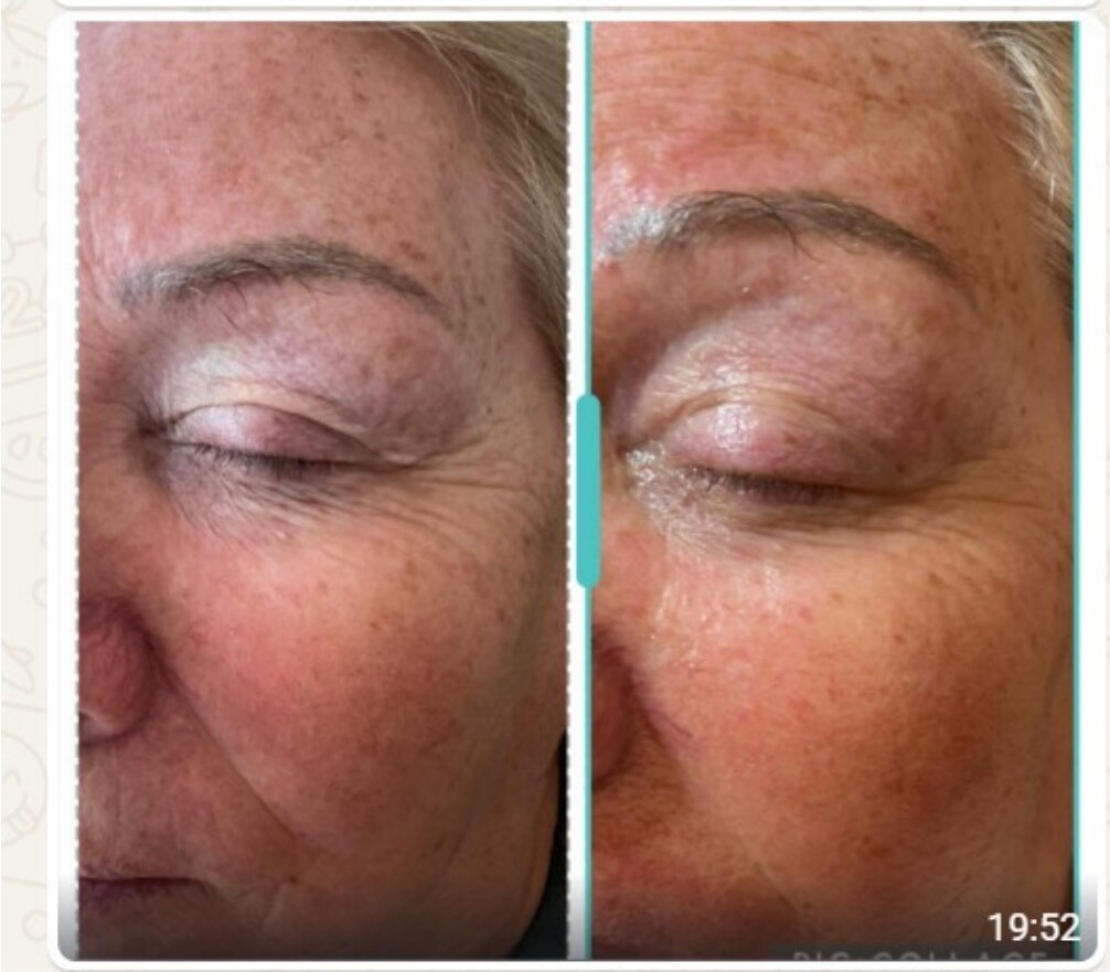 Skin hydration and glow result after treatment