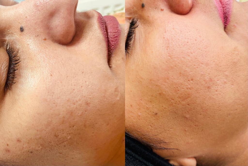 Before and after skin texture improvement