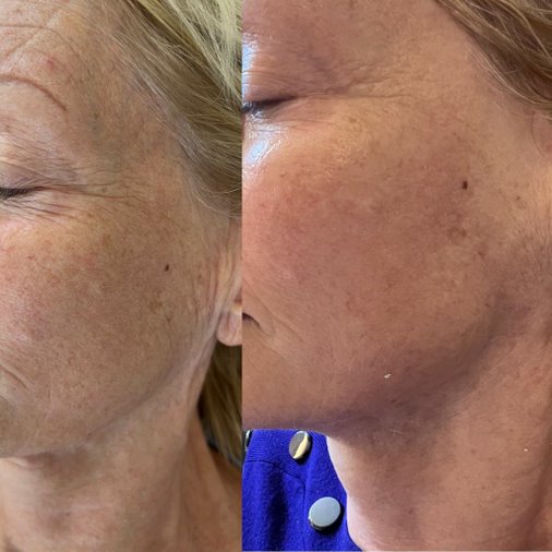 Before and after facial rejuvenation result